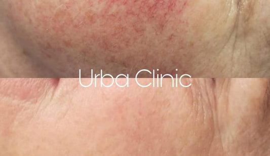 IPL skin rejuvenation programme